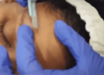 dermaplaning dermaplaning