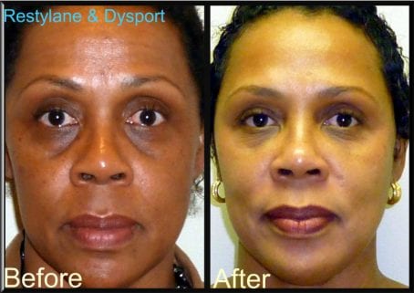 fillers fillers