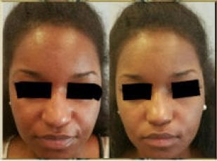 vampire_facelift
